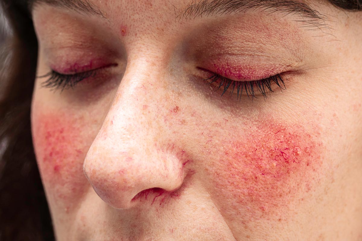 Rosacea auf den Wangen