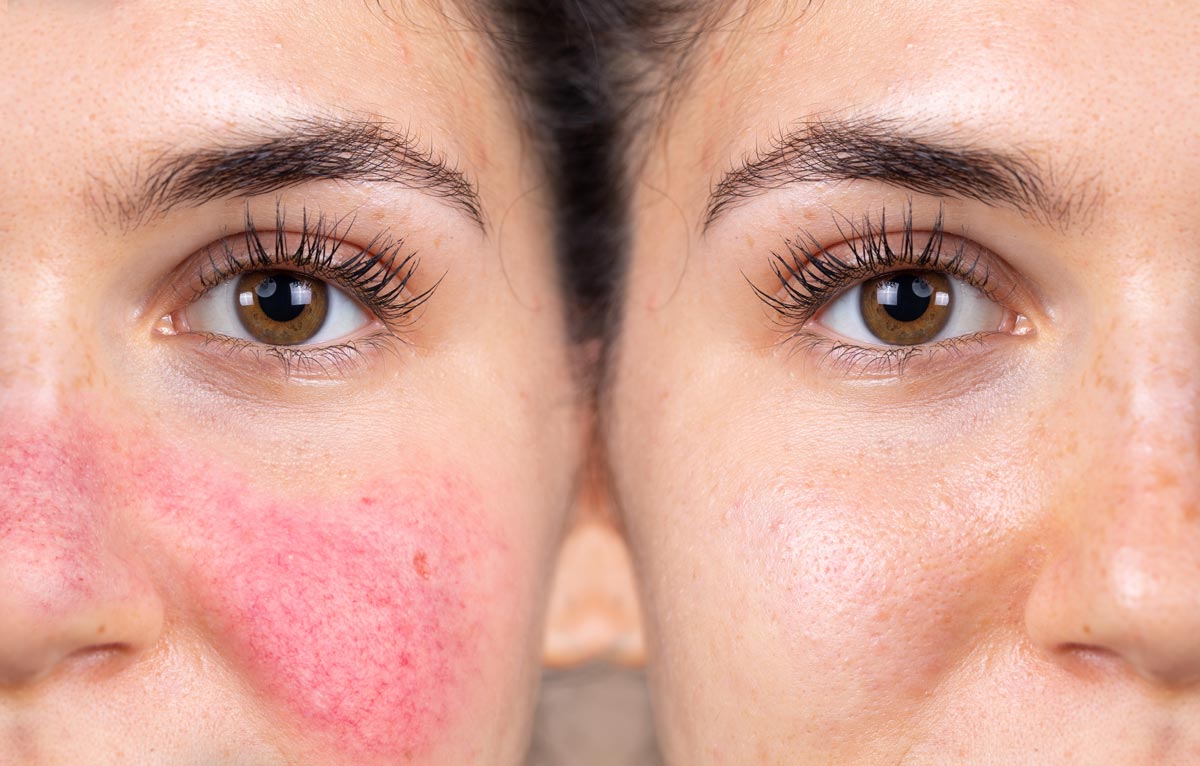 Rosacea Vorher Nachher Vergleich