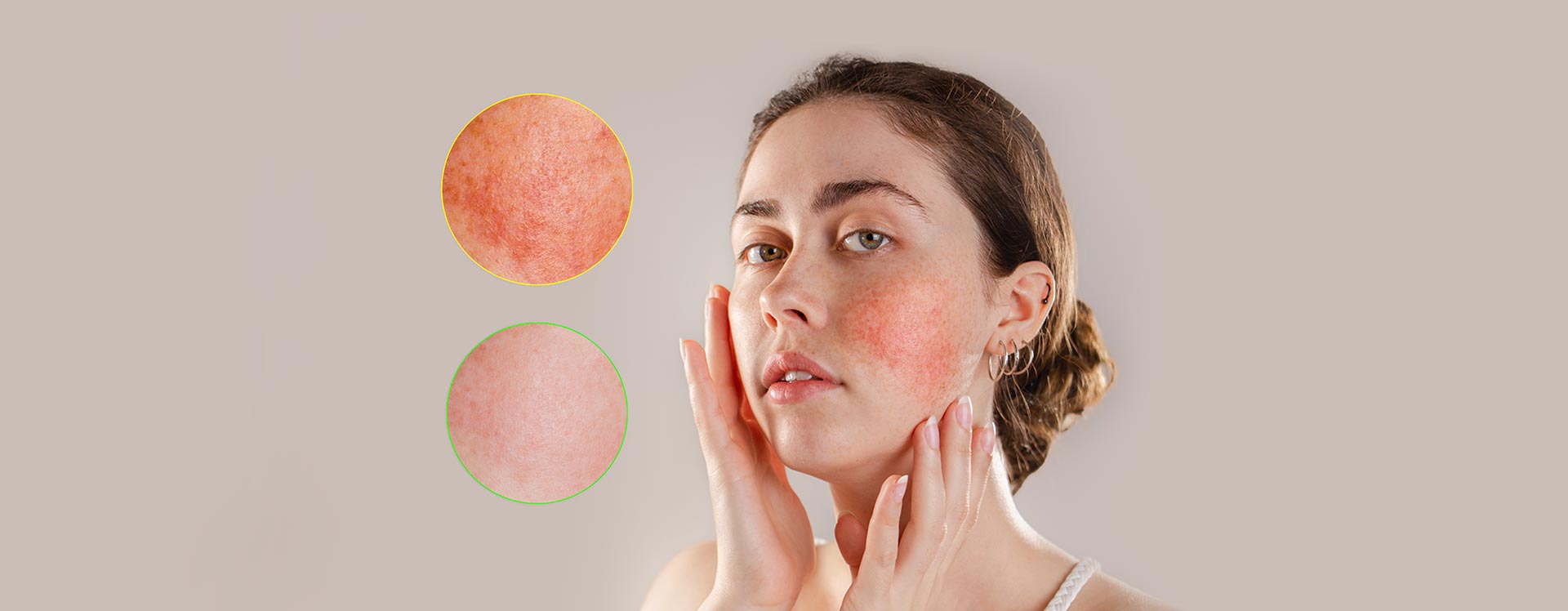 Rosacea im Gesicht