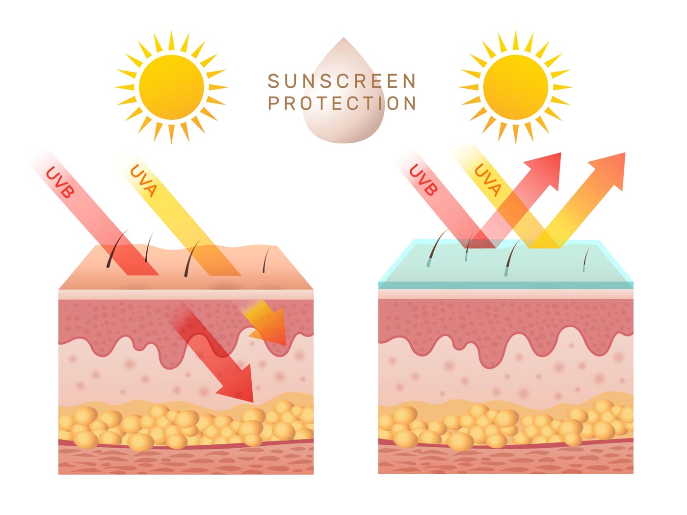 Vorsicht vor Sonnenbrand, Sonnenstich und Hitzeerschöpfung: Sonnenschutz  für Kinder - PTAheute