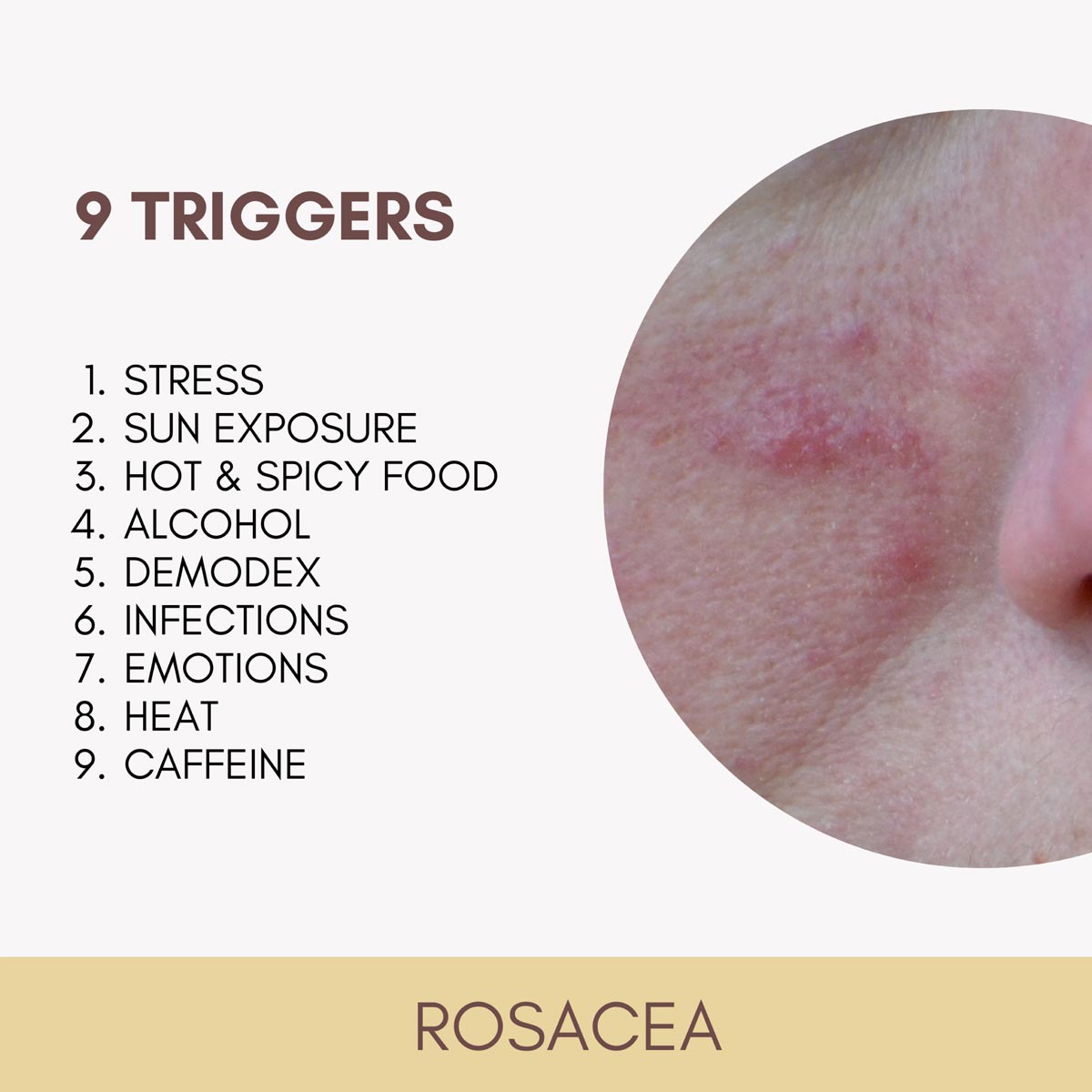 rosacea_trigger Was sind Rosacea trigger?