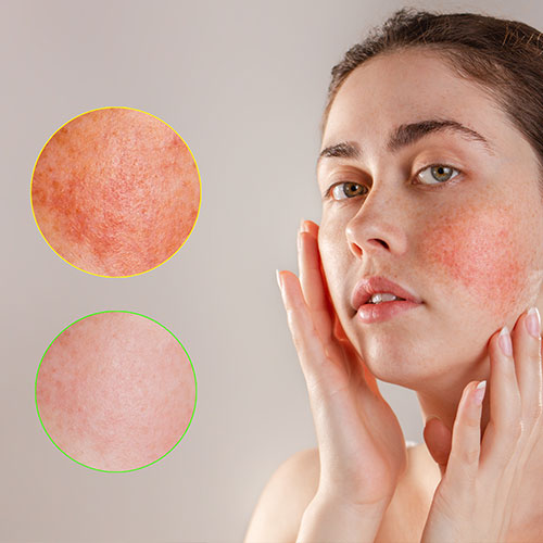 Was ist Rosacea? Symptome, Behandlung und Pflege